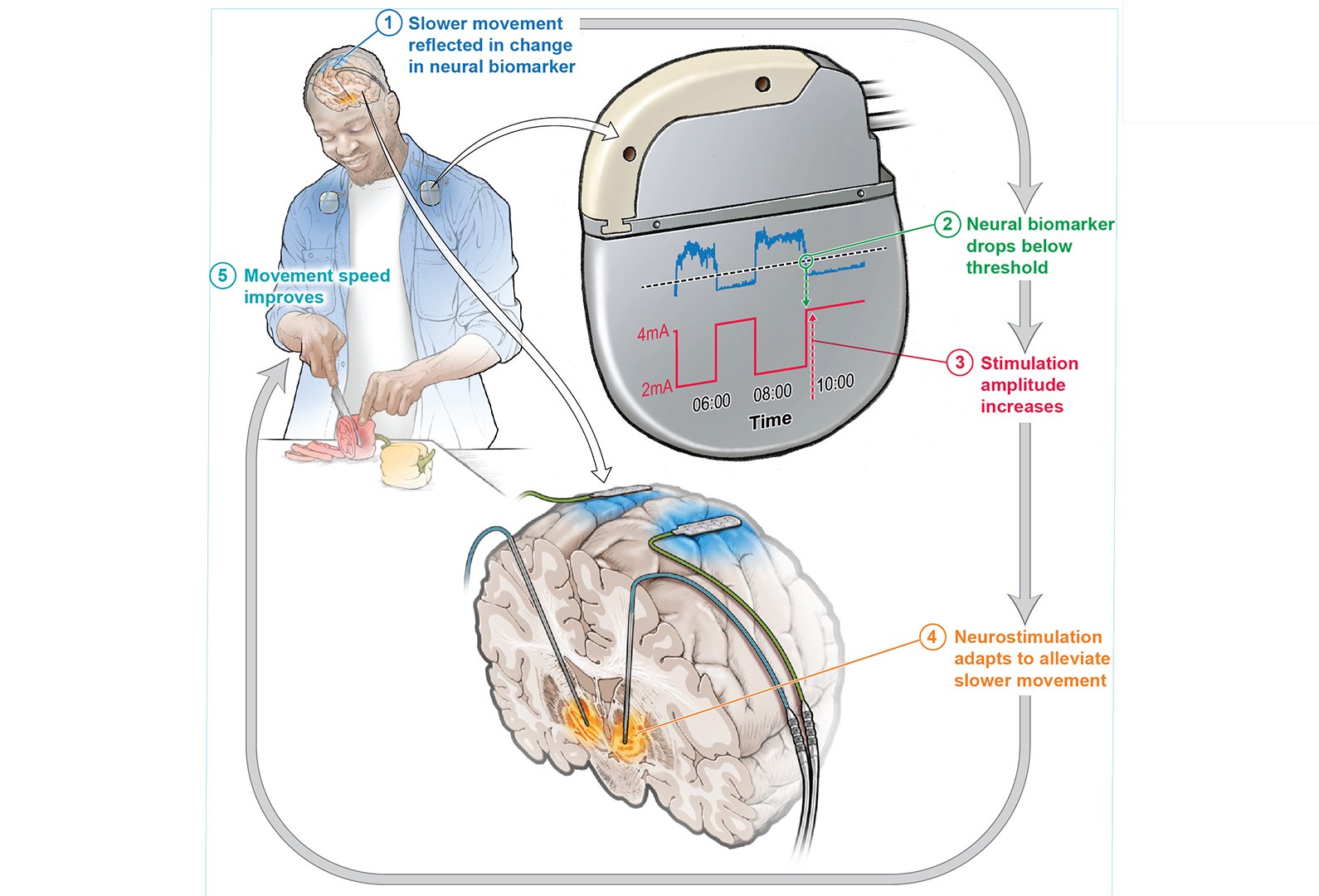 Parkinson’s Disease Around the World